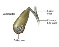 7-gallstones