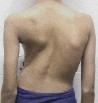 8-scoliosis