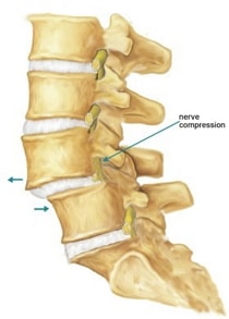 8-spondylosis